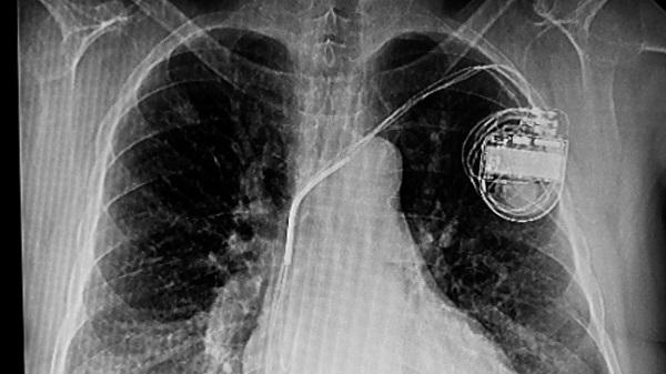 Most Infected Cardiac Implanted Electronic Devices Not Removed Fast Enough