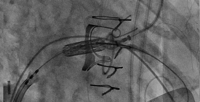  Minimalist Valve-in-Valve TMVR as Safe as Conventional Approach 