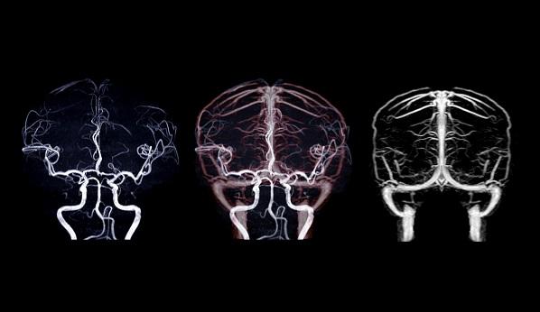 CASSISS: No Benefit of Stenting for Intracranial Stenosis