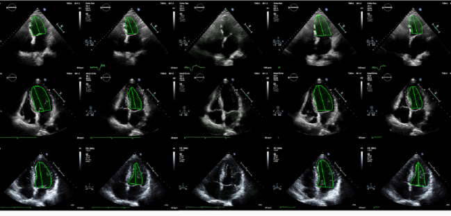 EchoNet AI Algorithm Beats Sonographers for Estimating LV Function