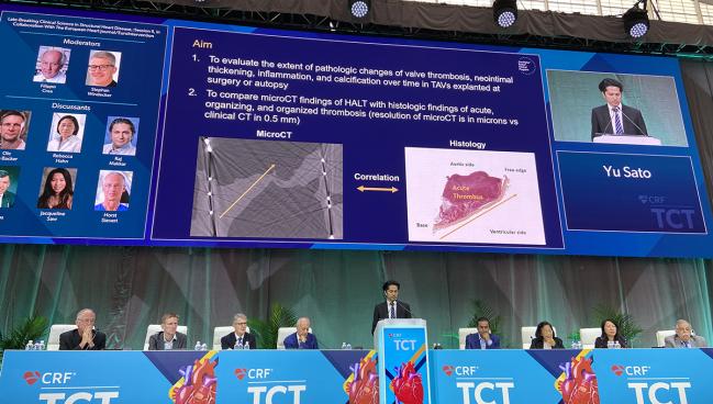 As Time Goes By, Post-TAVI Thrombus Becomes More OAC Resistant