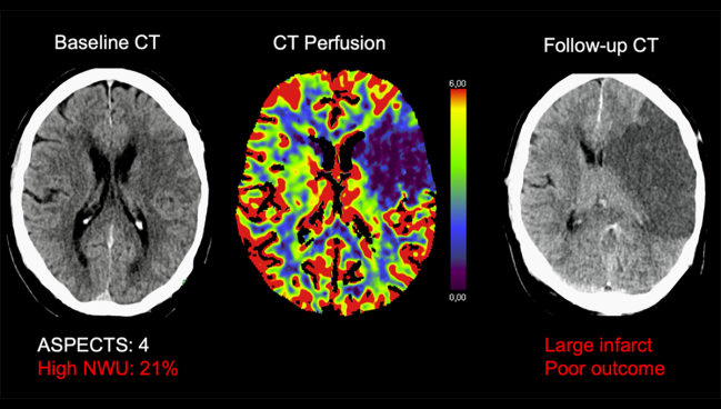 Stroke Thrombectomy May Work for Large Infarcts in the Late Time Window 