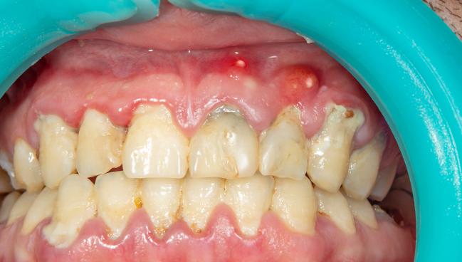Atrial Fibrosis Mediated by Gum Disease May Be Missing AF Link