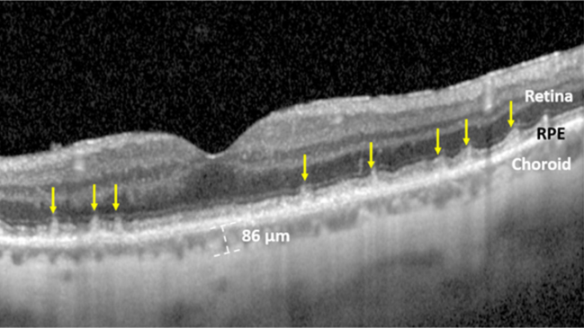 Age-Related Macular Degeneration Linked To Severe Vascular Disease ...