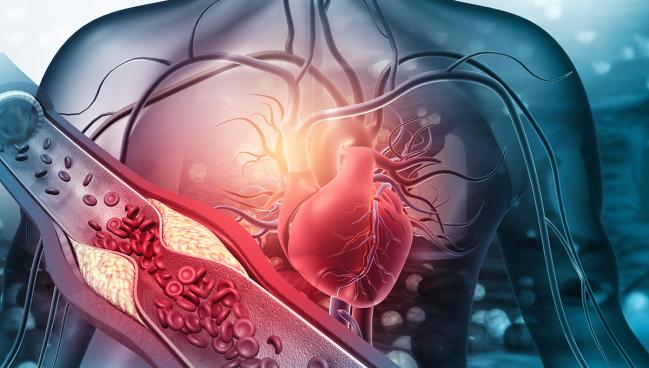 Anatomic Disease After PCI Linked With Worse Outcomes: VA CART