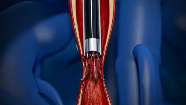 Lasers a Valuable Tool to Retrieve Embedded IVC Filters: Multicenter Study