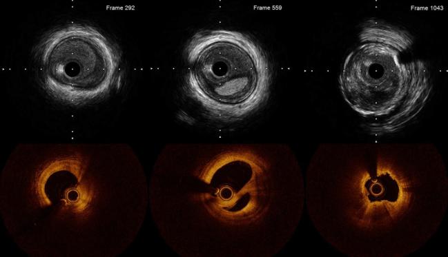 Intravascular Imaging to Inform PCI Should Be Routine: ACC Interventional Council
