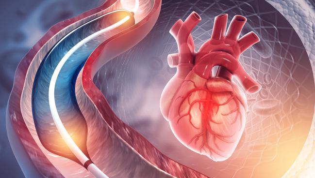 Long-term Data Support Paclitaxel-Coated Balloons for In-Stent Restenosis