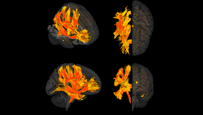 Brain Areas Identified Linking High BP and Cognitive Impairment