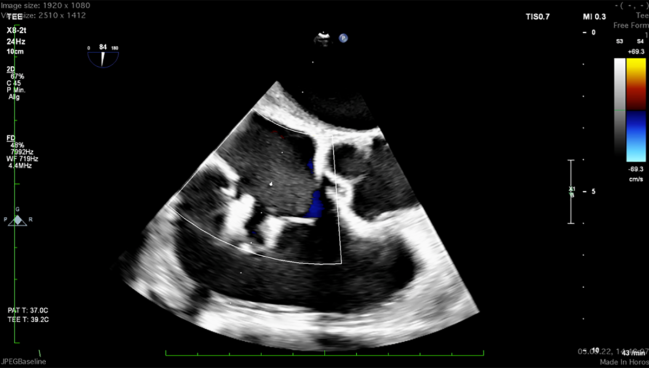 Higher Gradient After Tricuspid TEER Not Harmful at 1 Year: TriValve Registry