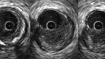 For Complex PCI, Intravascular Imaging Lowers Risk of Target Vessel Failure  