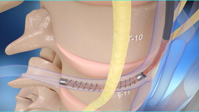 Preliminary Results Suggest Benefit of Splanchnic Nerve Ablation in HFpEF