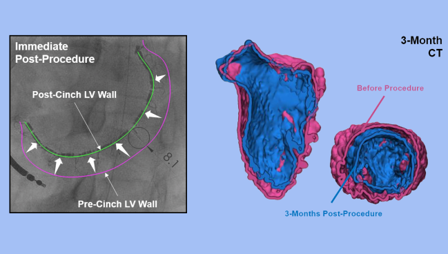 Promising Preliminary Results for AccuCinch LV Restoration System in HFrEF