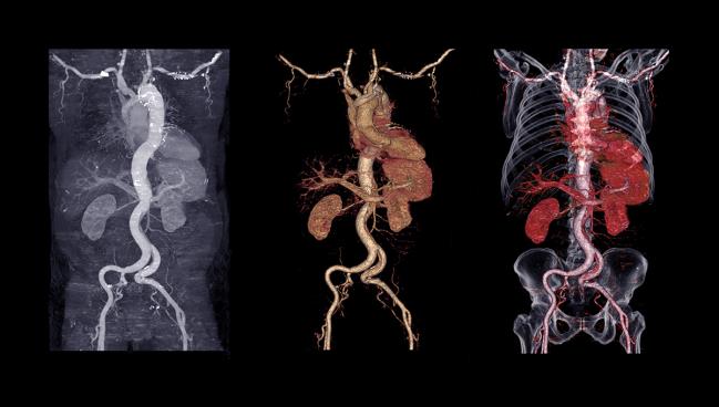 Aortic Disease Deaths Tied to Modifiable Risk Factors, Japanese Data Confirm