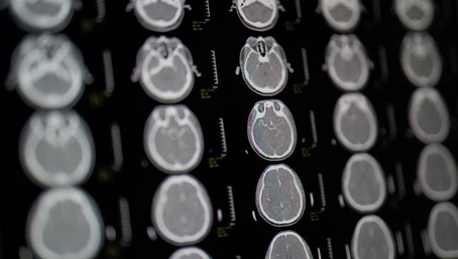 MR CLEAN-LATE Affirms 24-Hour Window Safe for Endovascular Stroke Therapy