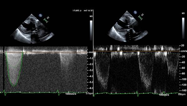 Five-Year Follow-up Reassures on Severe Patient-Prosthesis Mismatch in TAVI 