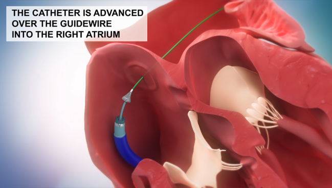 No-Implant Shunt for HF Looks Safe, Feasible in Early Snapshot