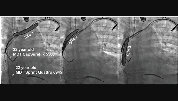 Shockwave Lithotripsy May Ease Transvenous Lead Extraction