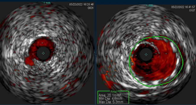 IVUS in Complex PCI Improves Outcomes, Even for Less-Experienced Operators