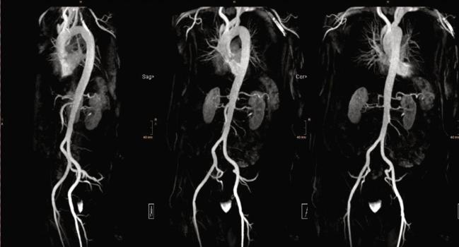 Cardiac MR Noninferior to CT for TAVI Planning, Small RCT Shows