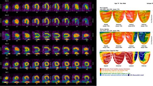 PET-Guided Strategy Lowers Risk, Boosts Outcomes in Stable CAD: CENTURY