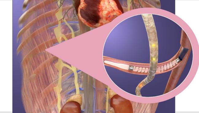 REBALANCE-HF Uncovers HFpEF Group That Responds to Splanchnic Nerve Ablation