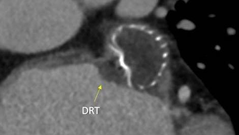 Outcomes Suffer When Device-Related Thrombus Persists or Recurs After LAAO