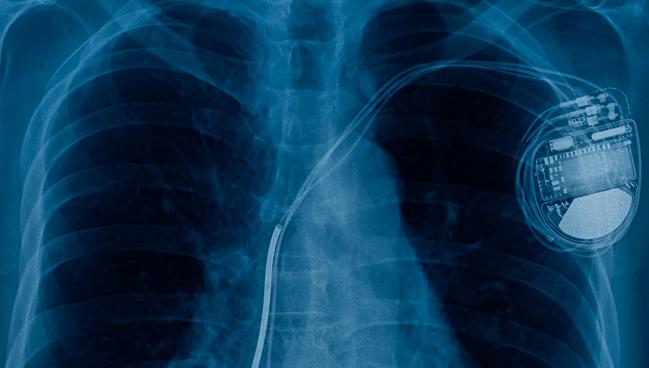 AHA Updates Its Scientific Statement on CIED Infections