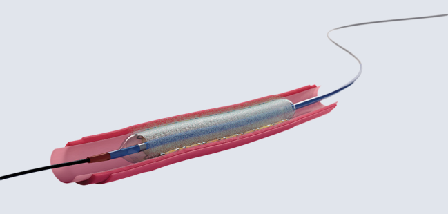 As US Rollout Begins for Coronary DCBs, Interventionalists Mull Practice Changes