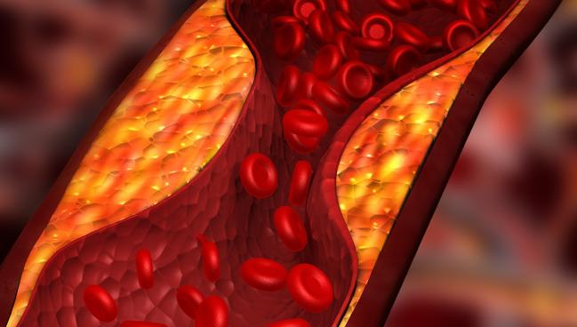 Atherosclerosis Progression May Share Traits With Tumor Growth