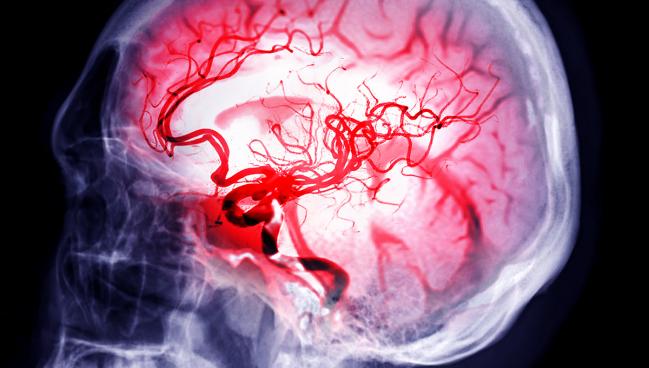 RAISE: Reteplase May Be Another Option for Stroke Thrombolysis