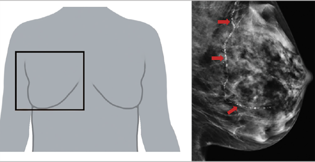 AI-Measured Breast Artery Calcification Tied to CV Outcomes in Women