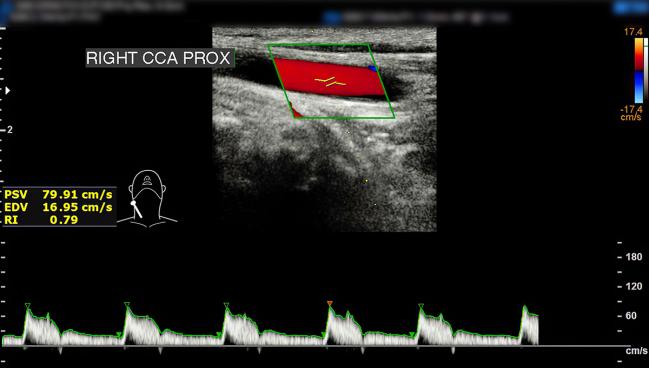 PERFORMANCE II: Low Stroke Rate Seen With All-Inclusive Carotid Stent