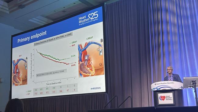CRT Patients Fare Better With LBB Area vs Biventricular Pacing 