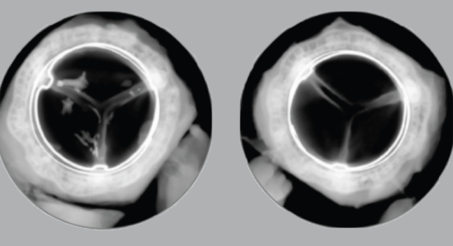 Solid Durability Seen With Surgical Resilia Tissue Aortic Valve 