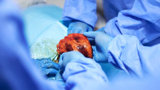 Donor Hearts Fare Better With Novel Method After Circulatory Death
