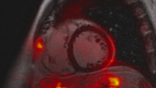 What’s the Damage With Long COVID Advanced Imaging Reveals Clues
