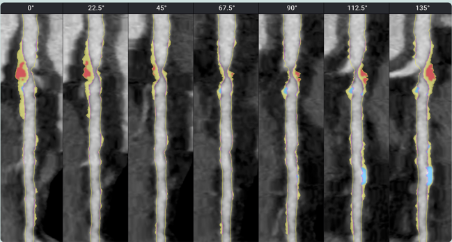 AI-QCT Possibly Lessens Gap Between Ideal vs Actual Care for Patients at Risk of ASCVD