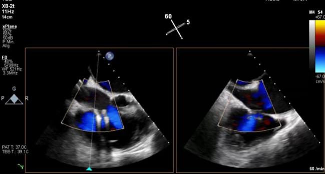 CMS Agrees to Reimburse Tricuspid TEER