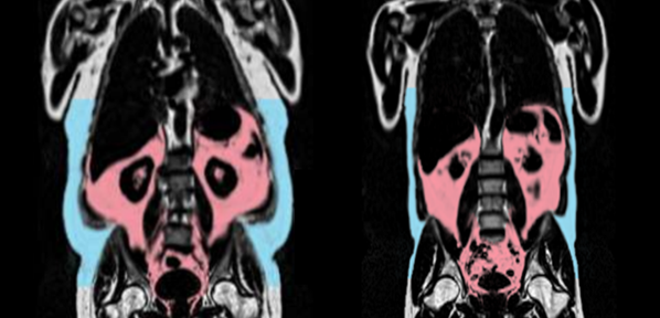 Body Fat Distribution Influences Cardiovascular Age