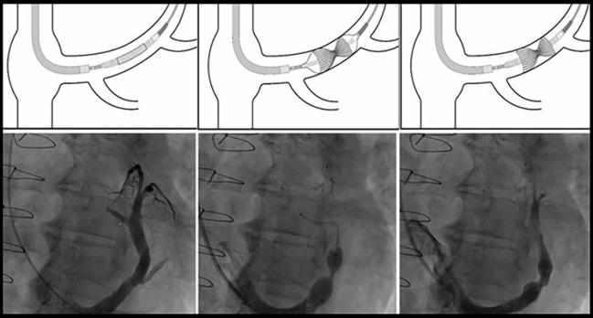 Coronary Sinus Reducer ‘Promising’ for Refractory Angina: Meta-analysis
