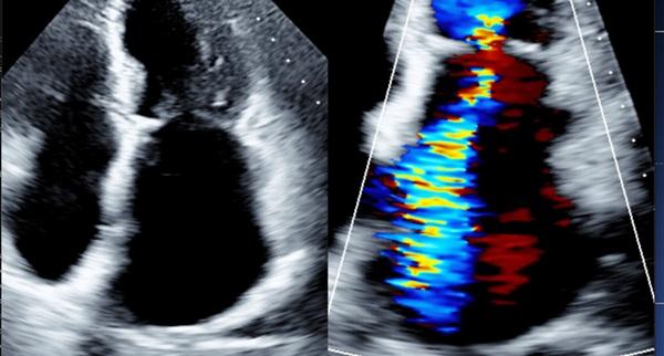 TEER May Surpass Medical Therapy in High-risk Atrial FMR Patients