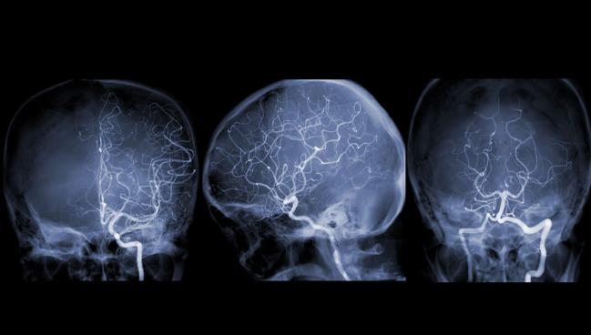 Long-Awaited CREST-2 Results Bolster Stents for Asymptomatic Carotid Stenosis