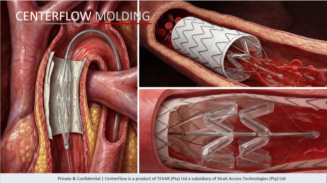 Strait Access Technologies Achieves First-in-Human Milestone with CenterFlow® Following TEVAR
