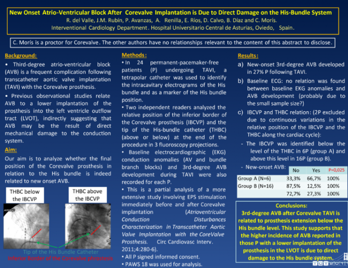 New Onset Atrio-Ventricular Block After Corevalve Implantation is Due to Direct Damage On the His-Bundle System.