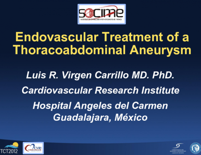 Endovascular Treatment of a Thoracoabdominal Aneurysm