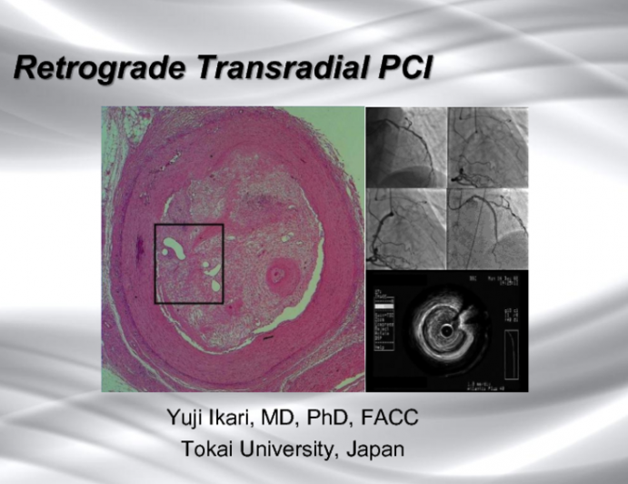 Transradial Retrograde Approach for a Chronic Total Occlusion