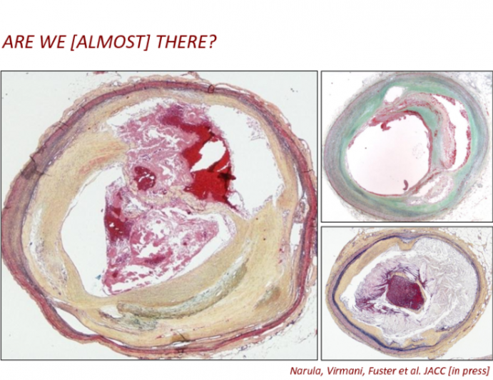 Advanced Imaging for Vulnerable Plaque Detection: The Future Is (Almost) Now!