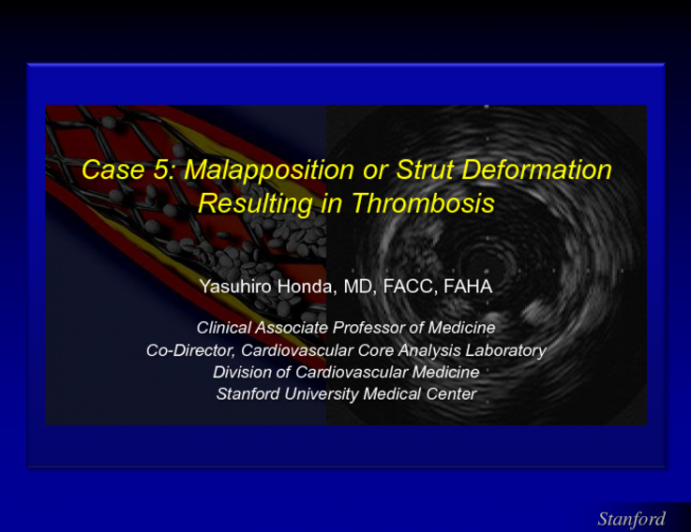 Case 5: Malapposition or Strut Deformation Resulting in Thrombosis