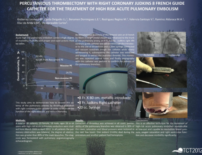 PERCUTANEOUS THROMBECTOMY WITH RIGHT CORONARY JUDKINS 8 FRENCH GUIDE CATHETER FOR THE TREATMENT OF HIGH RISK ACUTE PULMONARY EMBOLISM